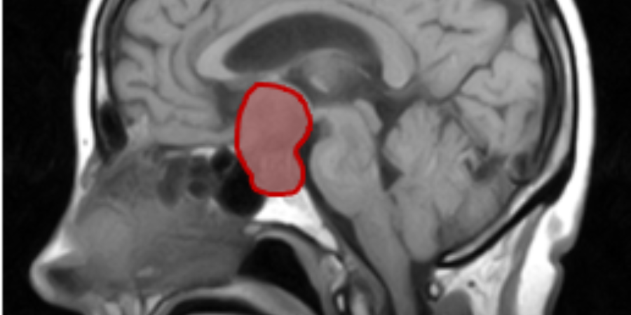 adenoma ipofisario